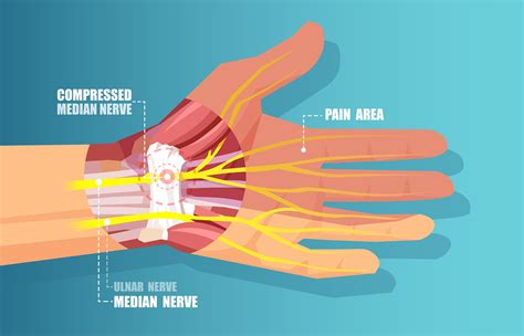 In certain cases, your physician may recommend surgery to remove a cyst, tumor or broken bone pressing on the nerve or repair the nerve itself. . How to treat nerve damage from handcuffs